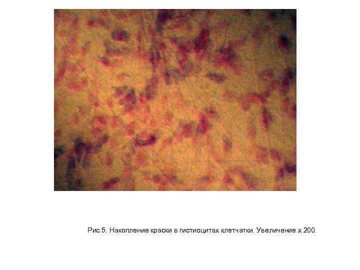 Рис. 5. Накопление краски в гистиоцитах клетчатки. Увеличение х 200. 