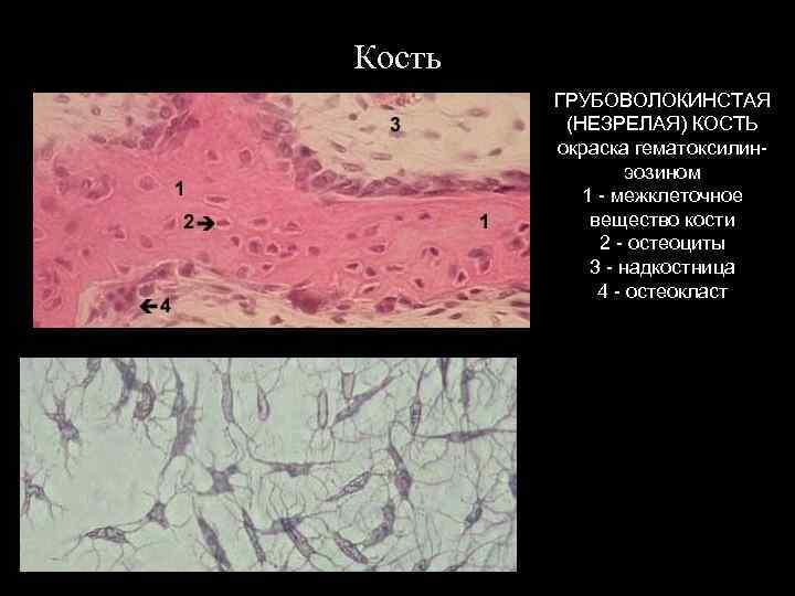 Кость ГРУБОВОЛОКИНСТАЯ (НЕЗРЕЛАЯ) КОСТЬ окраска гематоксилинэозином 1 - межклеточное вещество кости 2 - остеоциты
