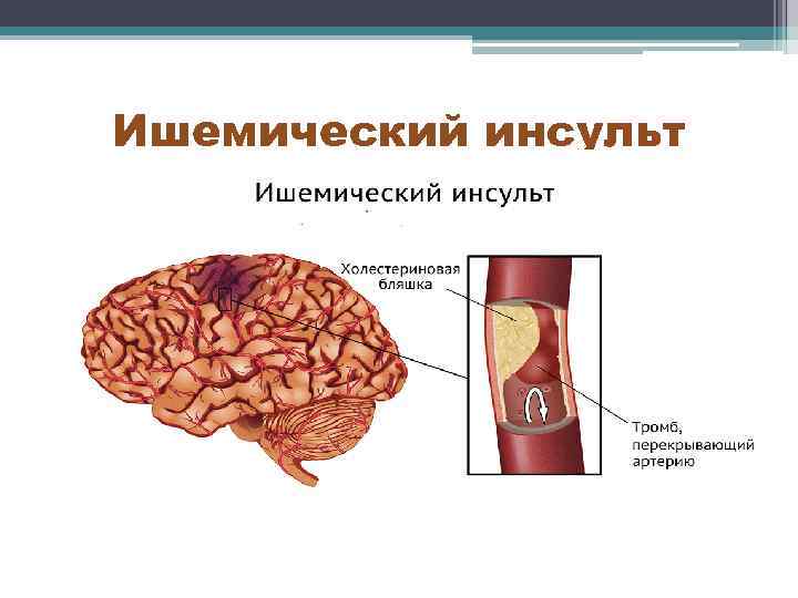 Ишемический инсульт 