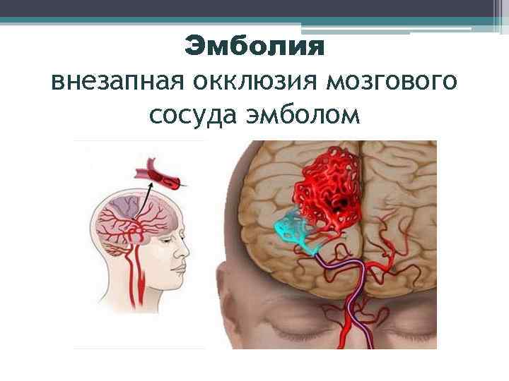 Последствия инфаркта мозга