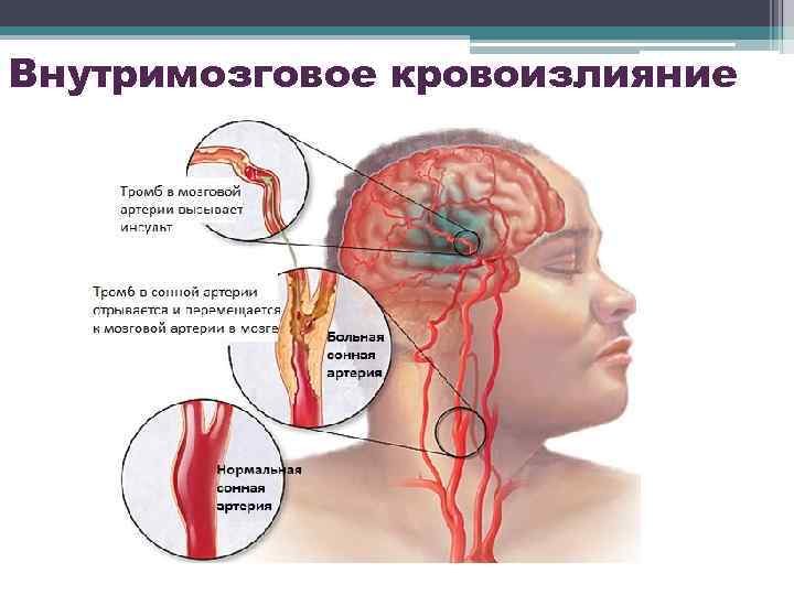 Внутримозговое кровоизлияние 