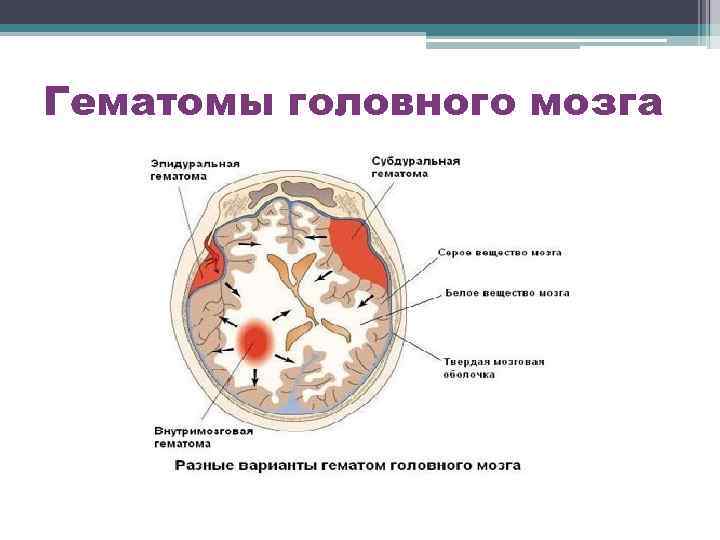 Гематомы головного мозга 