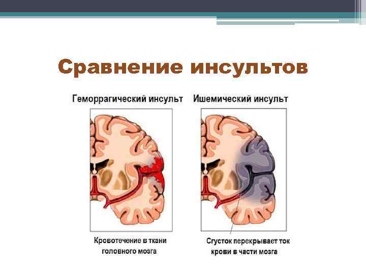 Сравнение инсультов 