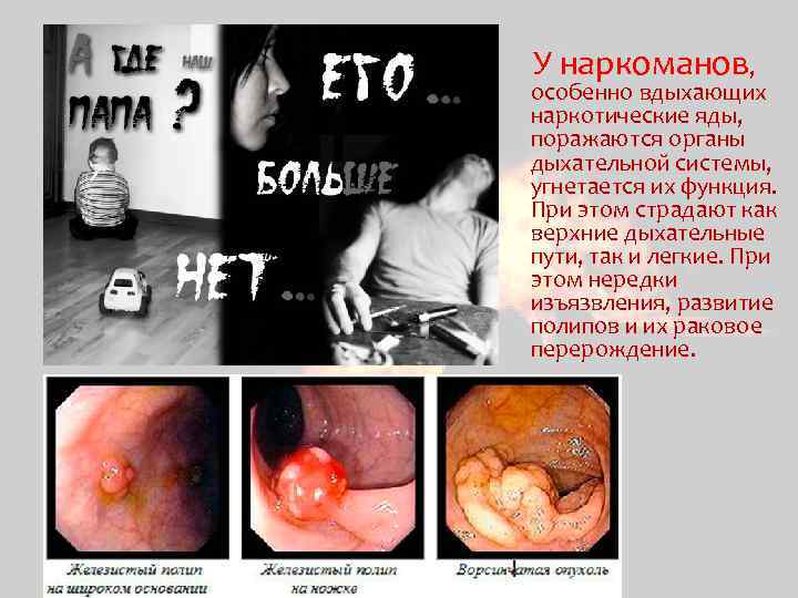  У наркоманов, особенно вдыхающих наркотические яды, поражаются органы дыхательной системы, угнетается их функция.