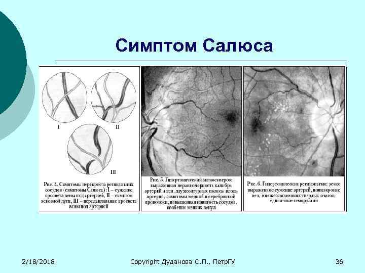 Симптом Салюса 2/18/2018 Copyright Дуданова О. П. , Петр. ГУ 36 
