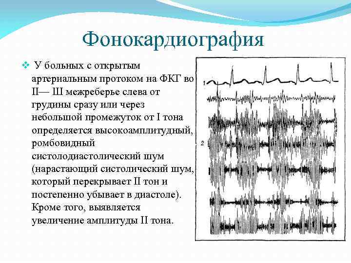 Фонокардиография v У больных с открытым артериальным протоком на ФКГ во II— Ш межреберье