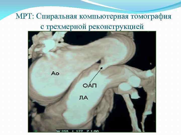  МРТ: Спиральная компьютерная томография с трехмерной реконструкцией 