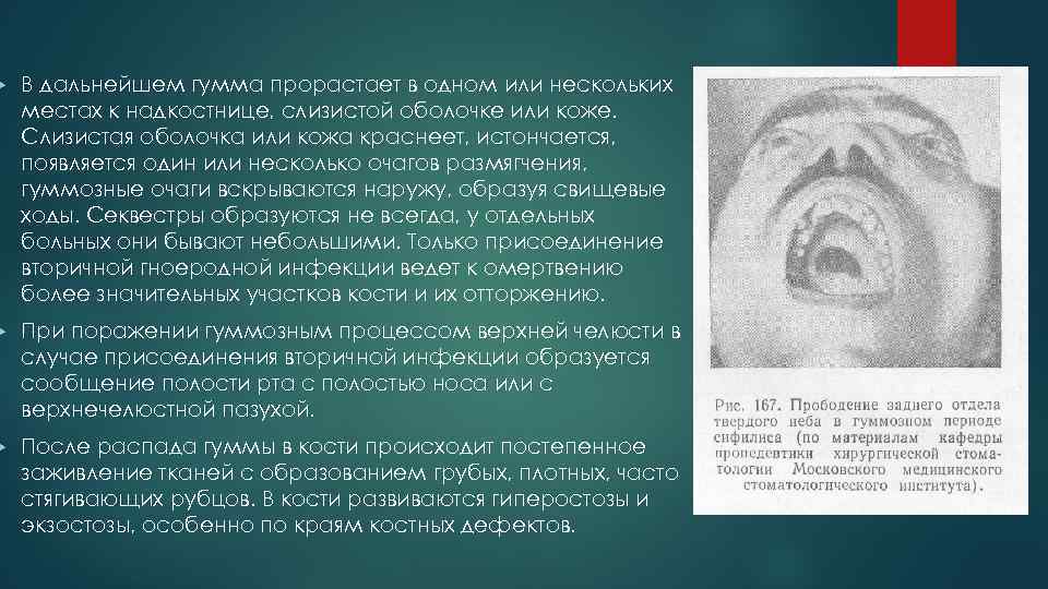  В дальнейшем гумма прорастает в одном или нескольких местах к надкостнице, слизистой оболочке