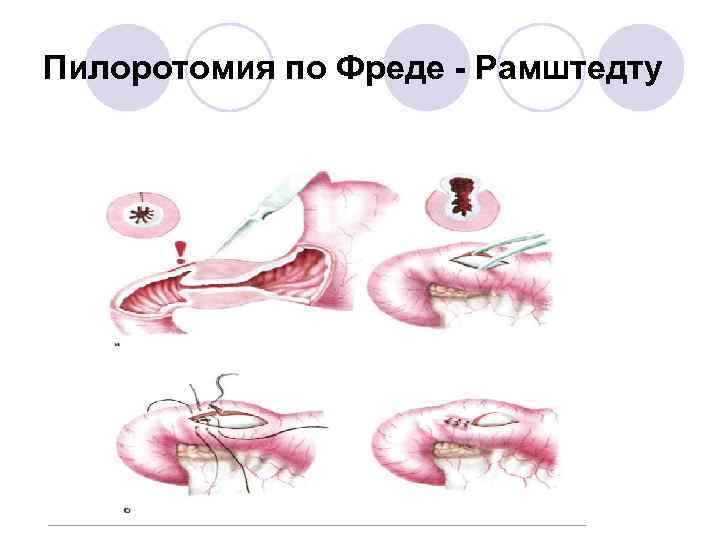 Пилоротомия по Фреде - Рамштедту 