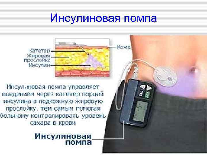 Инсулиновая помпа 