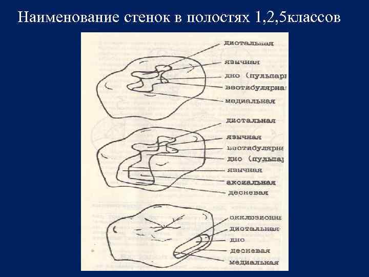 Полости 1. Названия стенок полости 1 класса. Стенки кариозной полости. Названия стенок кариозной полости. Название стенок полости 3 класса.