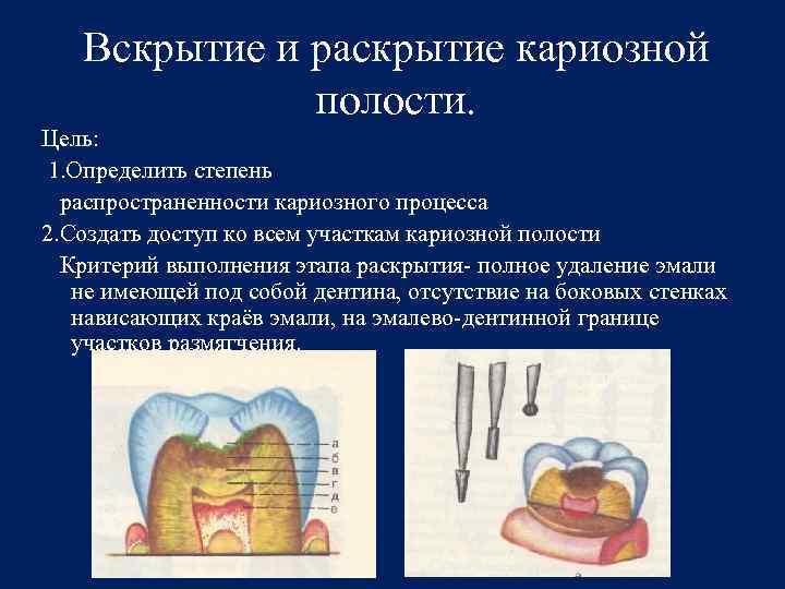 Полость проявление. Вскрытие и раскрытие кариозной полости. Раскрытие кариозной полости. Этапы раскрытия кариозной полости. Цель этапа раскрытия кариозной полости.