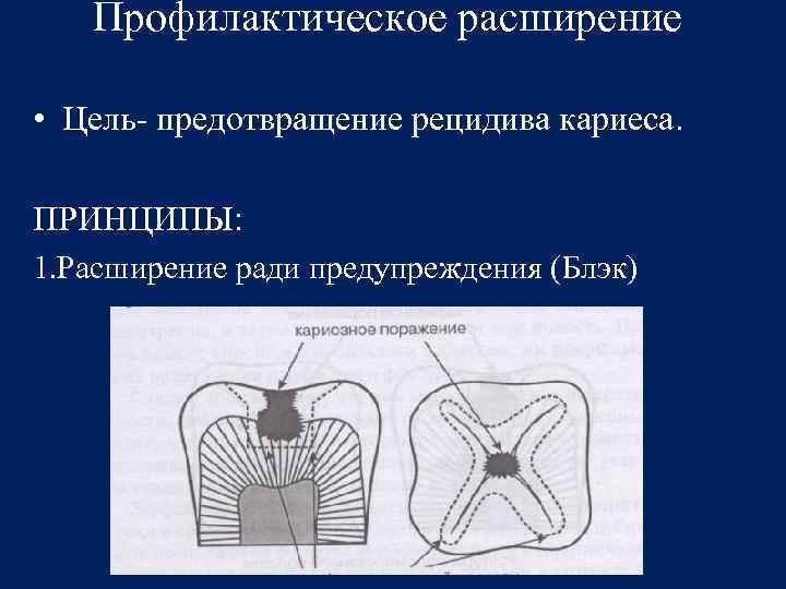 Профилактическое расширение • Цель- предотвращение рецидива кариеса. ПРИНЦИПЫ: 1. Расширение ради предупреждения (Блэк) 