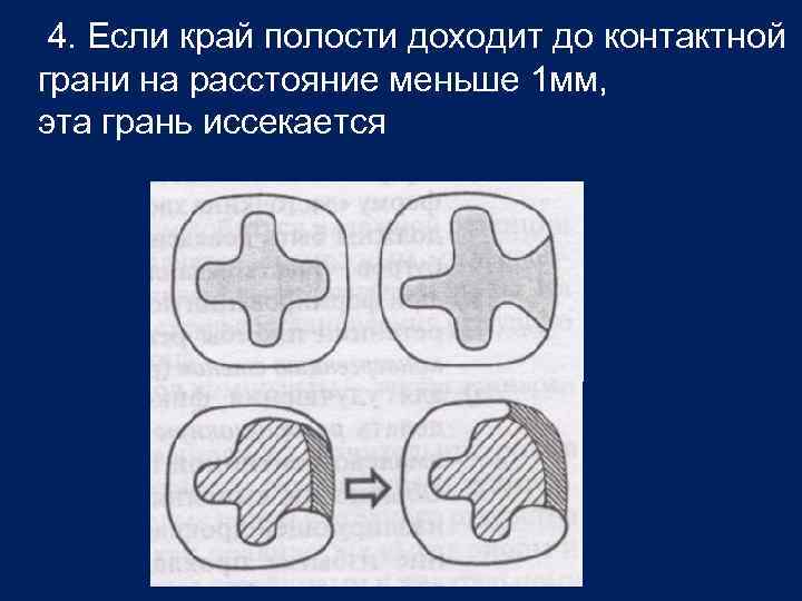 4. Если край полости доходит до контактной грани на расстояние меньше 1 мм, эта