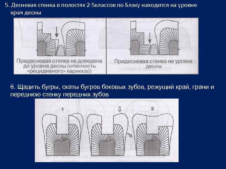 Стенки полостей. Формирование полости 5 класса по Блэку. Стенки кариозной полости 2 класса. Полость 5 класса по Блэку.