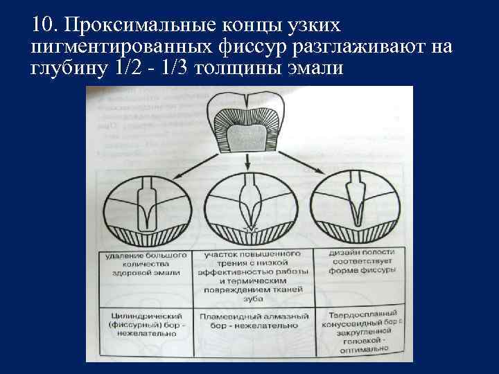10. Проксимальные концы узких пигментированных фиссур разглаживают на глубину 1/2 - 1/3 толщины эмали
