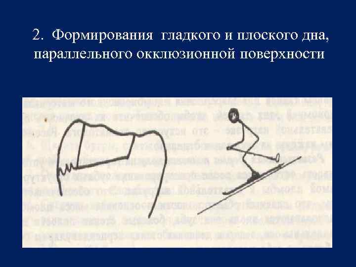 2. Формирования гладкого и плоского дна, параллельного окклюзионной поверхности 
