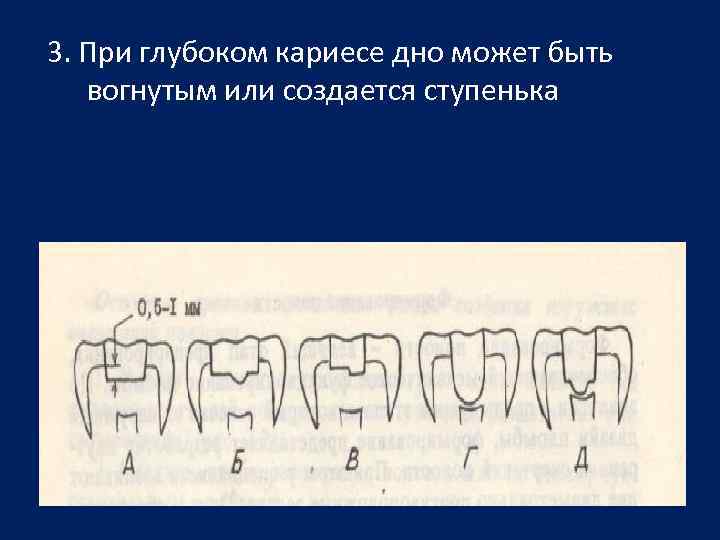 3. При глубоком кариесе дно может быть вогнутым или создается ступенька 
