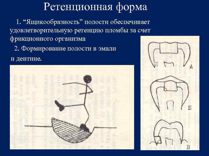 Полость формы. Ретенционная форма полости. Создание ретенционной формы полости. Ретенционная форма зуба.