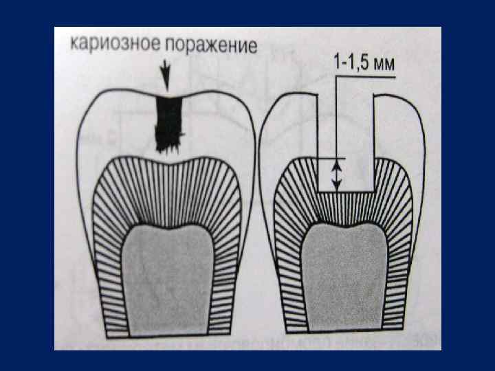 Классификация кариеса по блэку в картинках