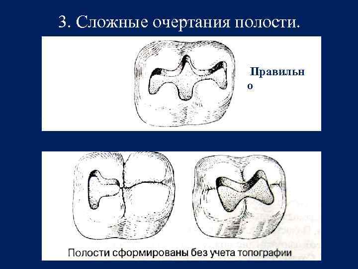 3. Сложные очертания полости. Правильн о 
