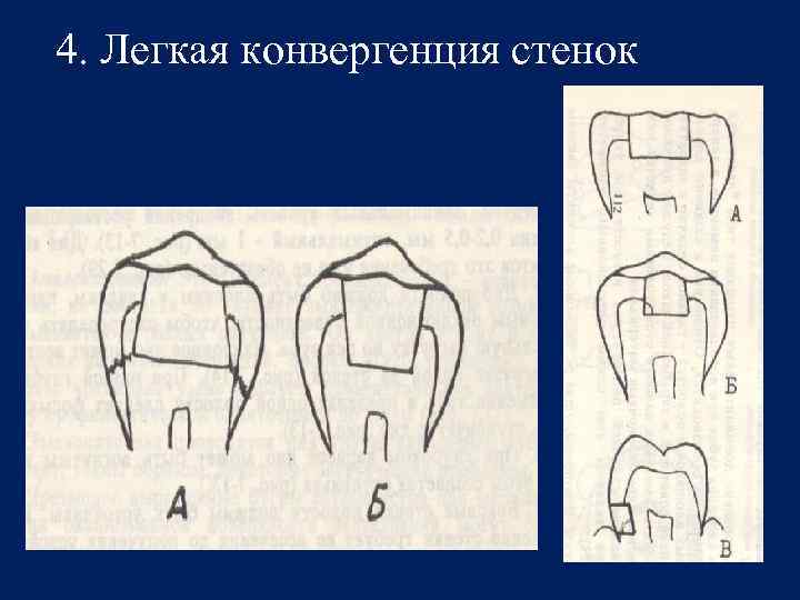 4. Легкая конвергенция стенок 