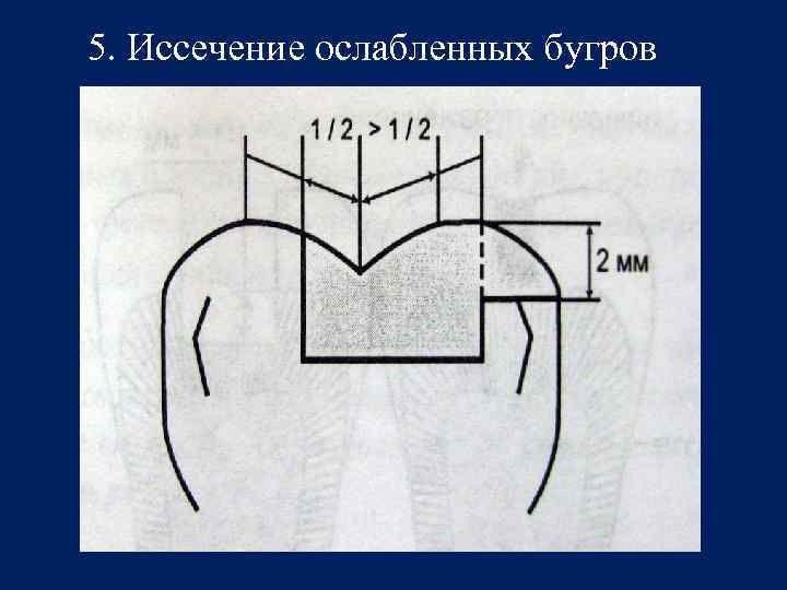 5. Иссечение ослабленных бугров 