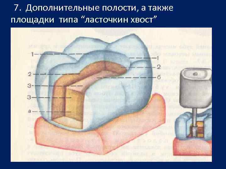 9 полостей. Элементы кариозной полости.