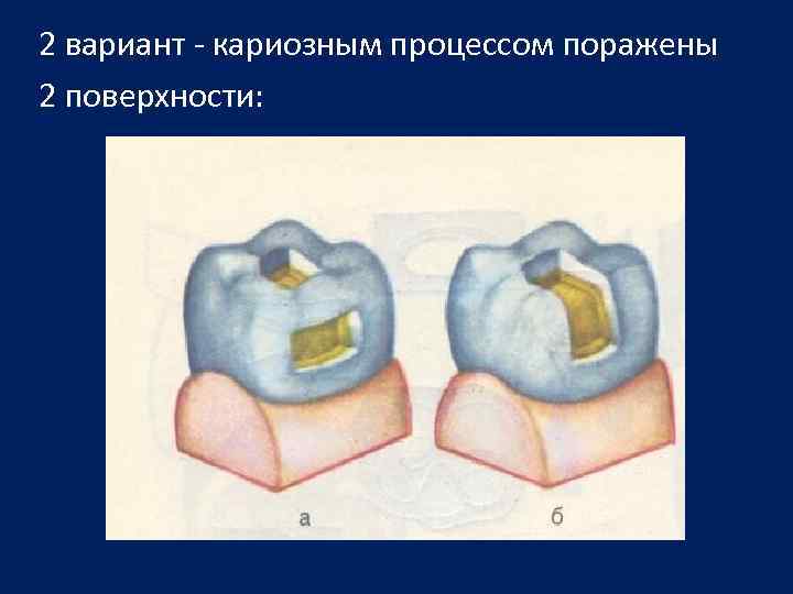 Размер кариозной полости. Классификация по Блеку кариозных полостей. Классификация полостей по Блэку. Кариозные полости по Блэку. Классификация кариеса по Блэку.