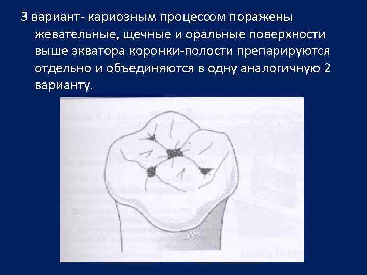 Полость привести. Перфорация дна кариозной полости. Перфорация стенки кариозной полости зуба. Чрезмерное расширение кариозной полости.