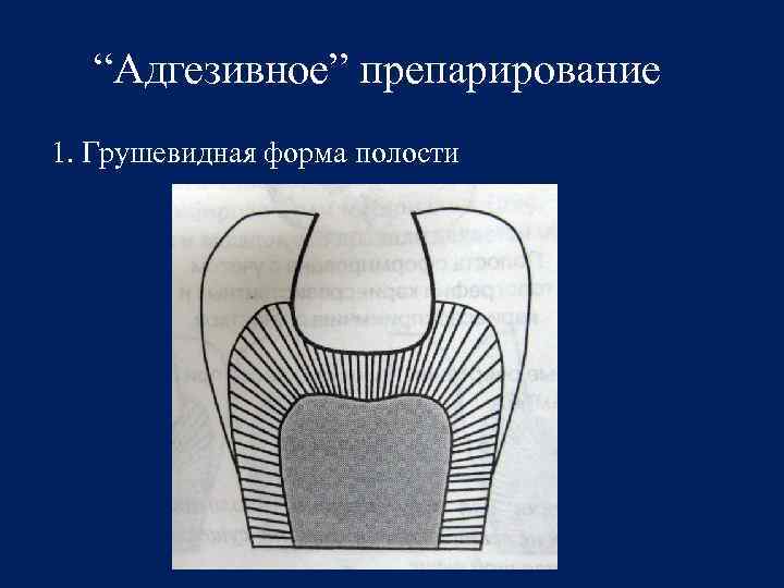 Края кариозной полости. Грушевидная форма полости. Адгезивное препарирование. Грушевидная форма полости зуба.