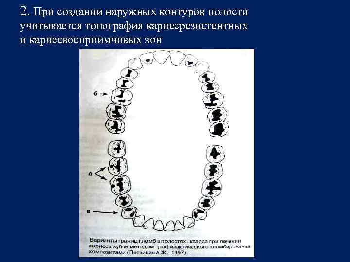 2. При создании наружных контуров полости учитывается топография кариесрезистентных и кариесвосприимчивых зон 