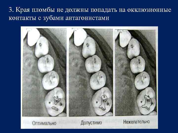 3. Края пломбы не должны попадать на окклюзионные контакты с зубами антагонистами 