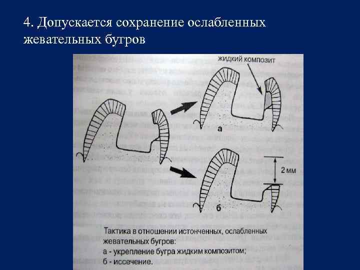 4. Допускается сохранение ослабленных жевательных бугров 