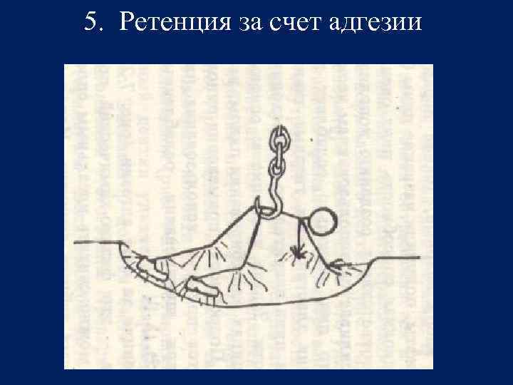 5. Ретенция за счет адгезии 