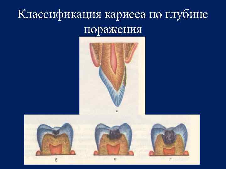 Классификация кариеса презентация