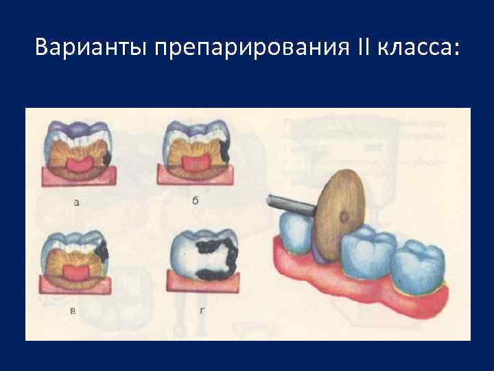 Препарирование кариозной полости 1 класса