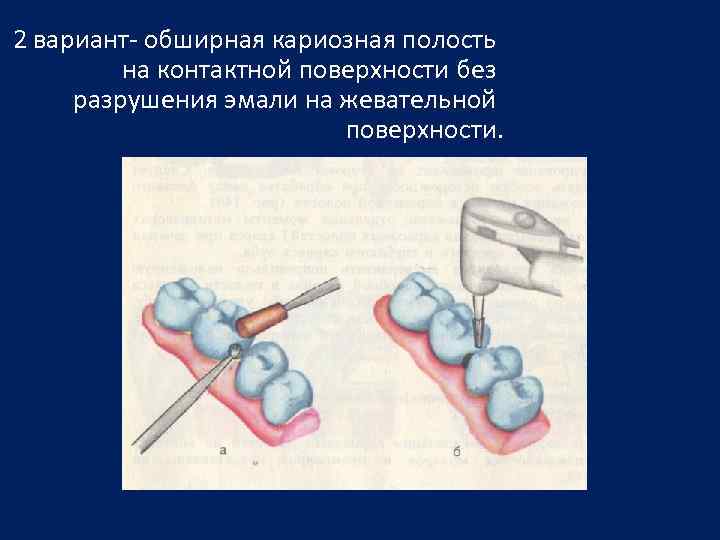 2 вариант- обширная кариозная полость на контактной поверхности без разрушения эмали на жевательной поверхности.