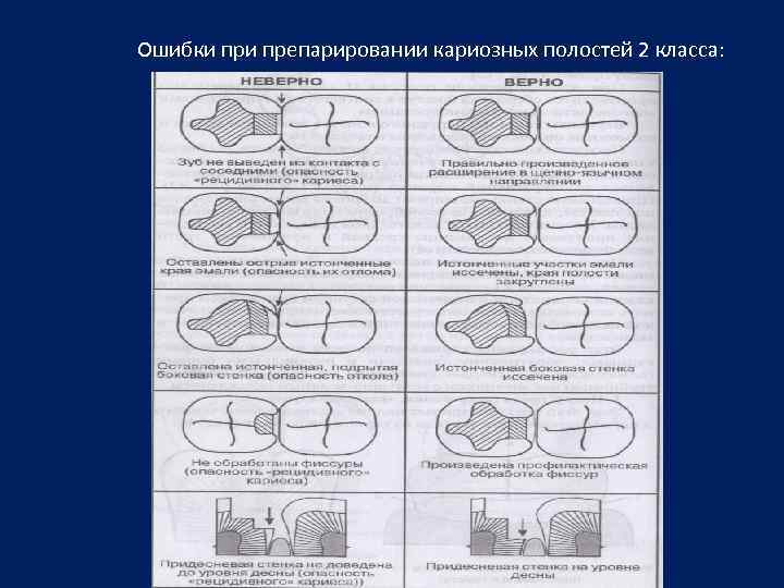 Препарирование кариозных полостей по классам