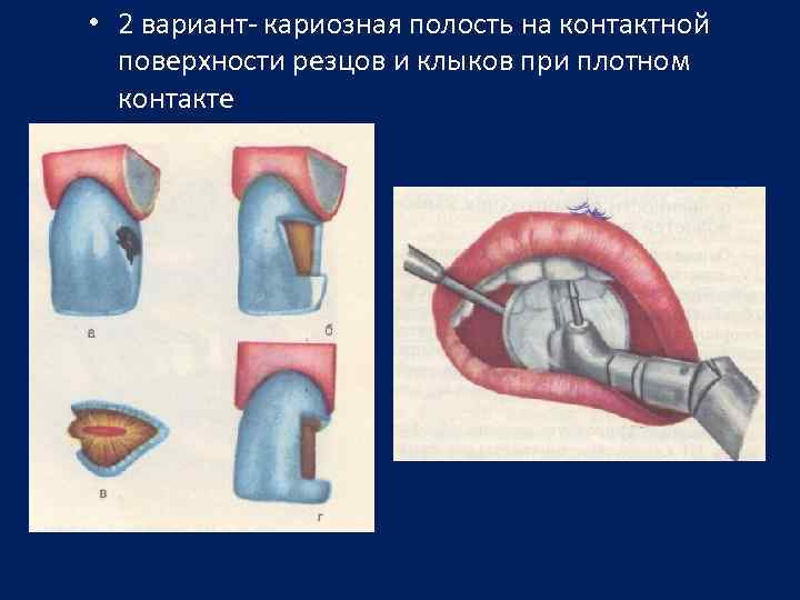  • 2 вариант- кариозная полость на контактной поверхности резцов и клыков при плотном