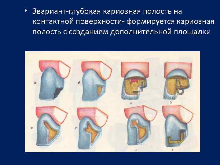 Размер кариозной полости. Кариозная полость на контактной поверхности. Доп площадка кариозной полости. Формирование кариозной полости с дополнительной площадкой.