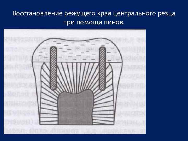Восстановление режущего края центрального резца при помощи пинов. 
