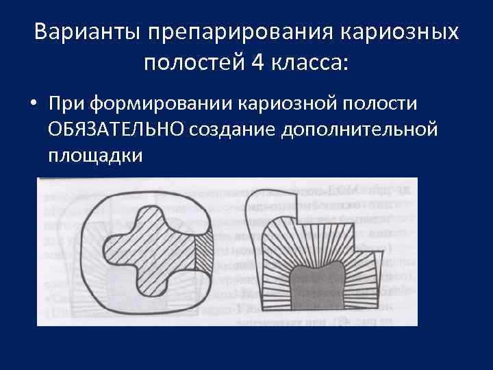 Кариозные полости 4 класса. Дополнительная площадка при препарировании кариозной. Кариозная полость 3 класс с доп площадки. Варианты препарирования полостей 2 класса. Варианты препарирования кариозных полостей.