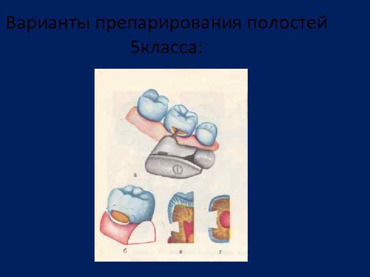 Кариозные полости 5 класса. Препарирование кариозных полостей 5 класса. Варианты формирования кариозных полостей 5 класса. Формирование кариозной полости класс. Формирование полости 5 класса.