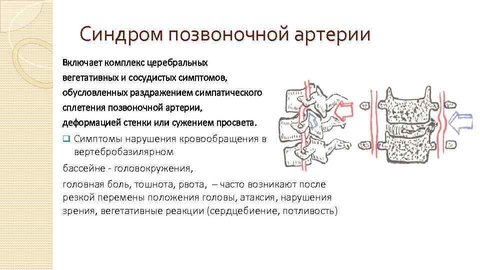 Синдром позвоночной артерии при шейном остеохондрозе лечение. Экстравазальная компрессия позвоночных вен. Сегмент v3 позвоночной артерии. Кровоток v2 позвоночной артерии. Синдом позвоночной артерии.