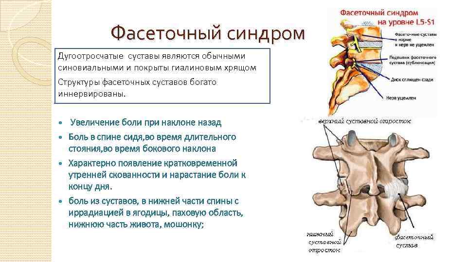  Фасеточный синдром Дугоотросчатые суставы являются обычными синовиальными и покрыты гиалиновым хрящом Структуры фасеточных
