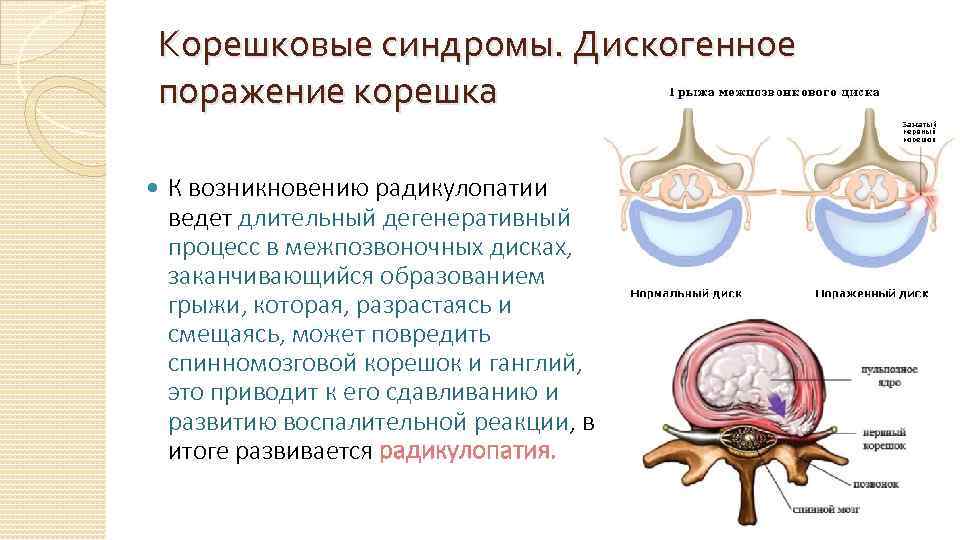 Корешковый синдром карта вызова