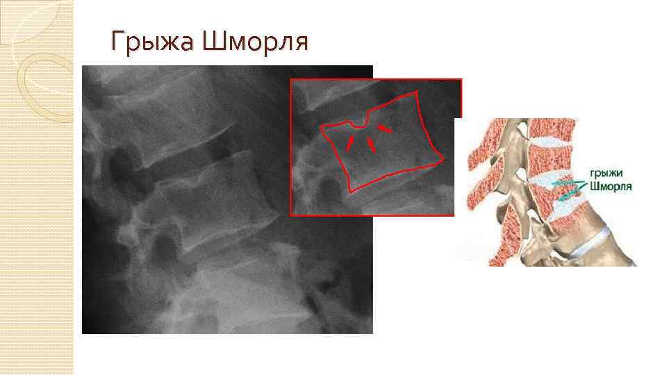 Грыжа Шморля 