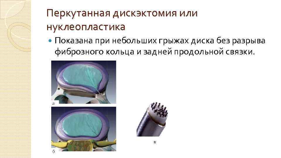 Перкутанная дискэктомия или нуклеопластика Показана при небольших грыжах диска без разрыва фиброзного кольца и