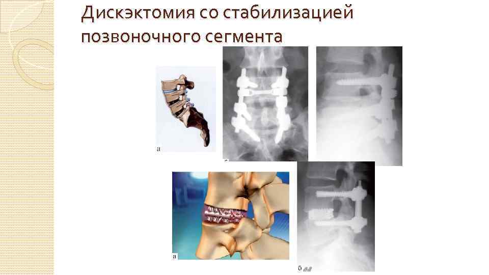 Дискэктомия со стабилизацией позвоночного сегмента 